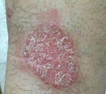 女性寻常型银屑病物理治疗