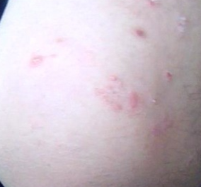 青年寻常型银屑病外用药