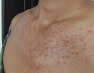 男人牛皮癣物理治疗