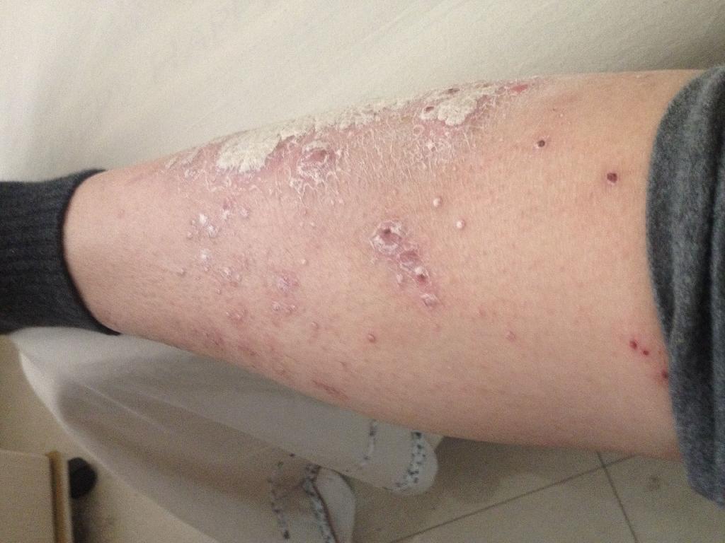 腿上长了牛皮癣会传染吗？