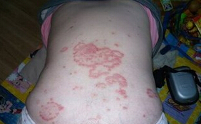 女子牛皮癣遗传吗？