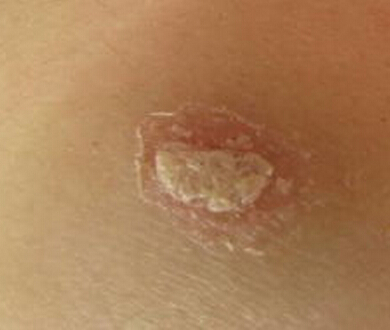 男子牛皮癣遗传吗？