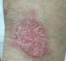 儿童关节病型牛皮癣西医病因