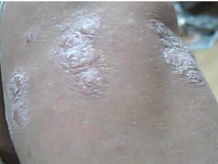 女性脓疱型牛皮癣预防措施有哪些