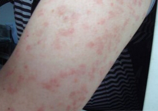 妇女牛皮癣预防扩散方法是什么？