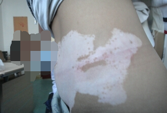 女性脓疱型牛皮癣实验室检查