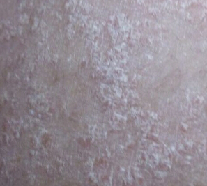 怎么护理牛皮癣？