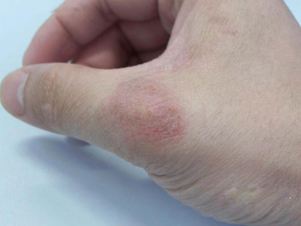 颈部牛皮癣护理方法有哪些
